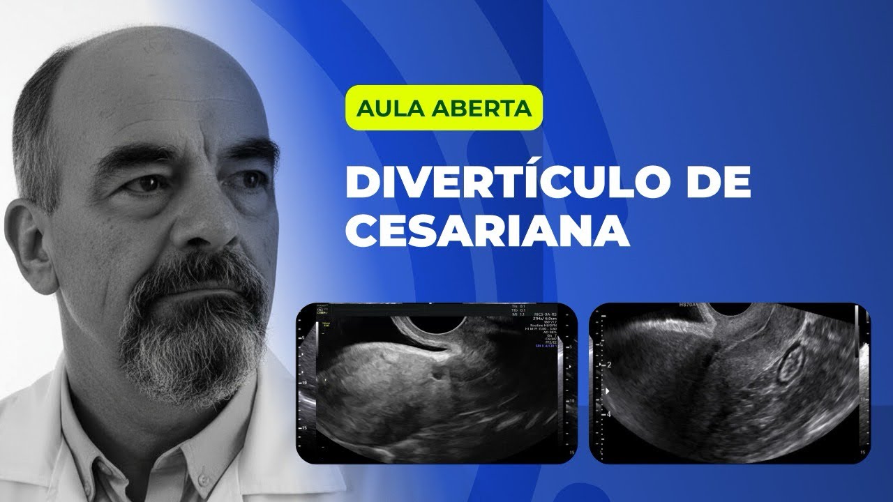 Divertículo de Cesariana: Diagnóstico e Riscos na Ultrassonografia