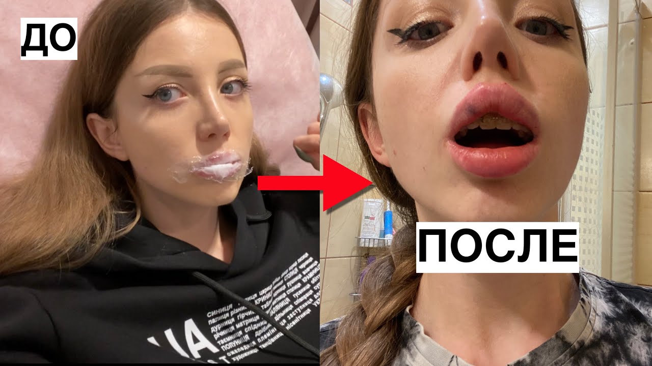 УВЕЛИЧИВАЮ ГУБЫ ПО ПРОСЬБЕ СВОЕЙ ДЕВУШКИ У ВРАЧА. НЕ В ПОДВОРОТНЕ!