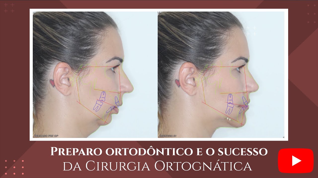 Preparo Ortodôntico e o sucesso da Cirurgia Ortognática - Caso Clínico