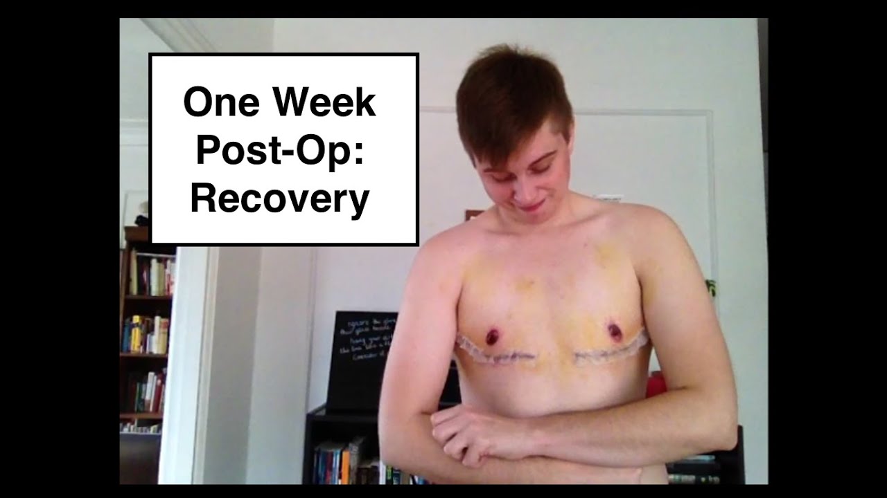 FTM Top Surgery - 1 Week Post Op!