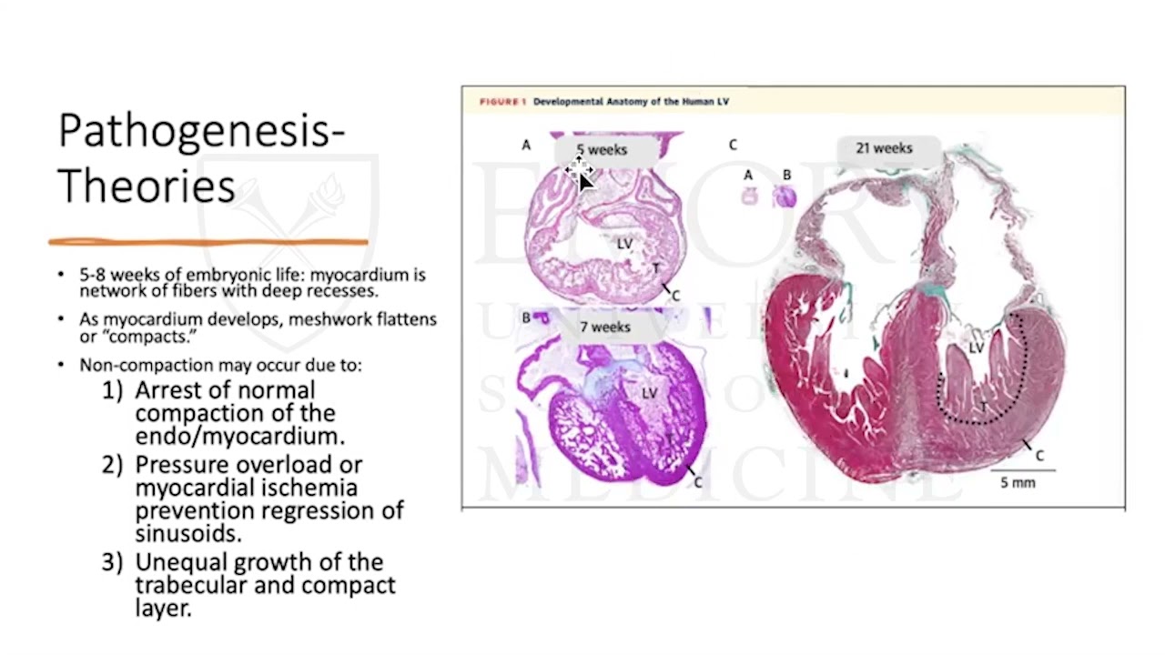 Left Ventricular Noncompaction: A phenotype, not a diagnosis