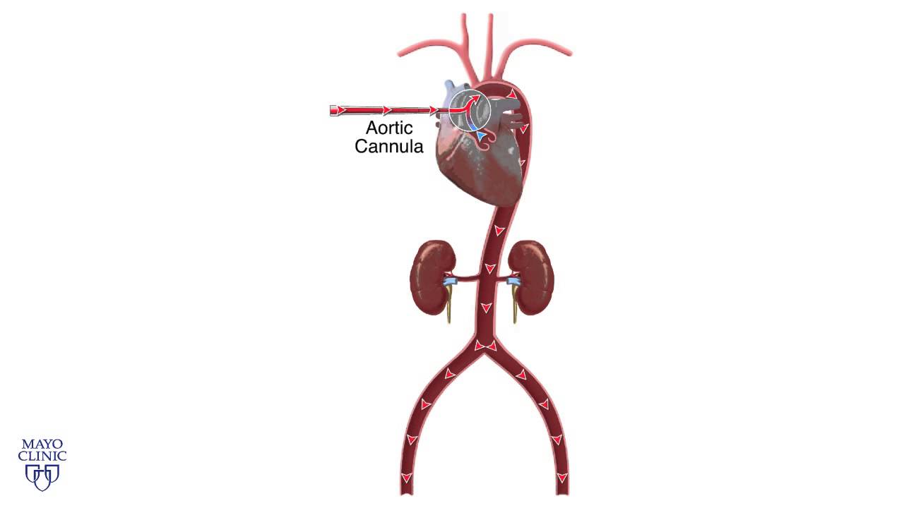 Central Cannulation and Veno-Arterial ECMO - Mayo Clinic