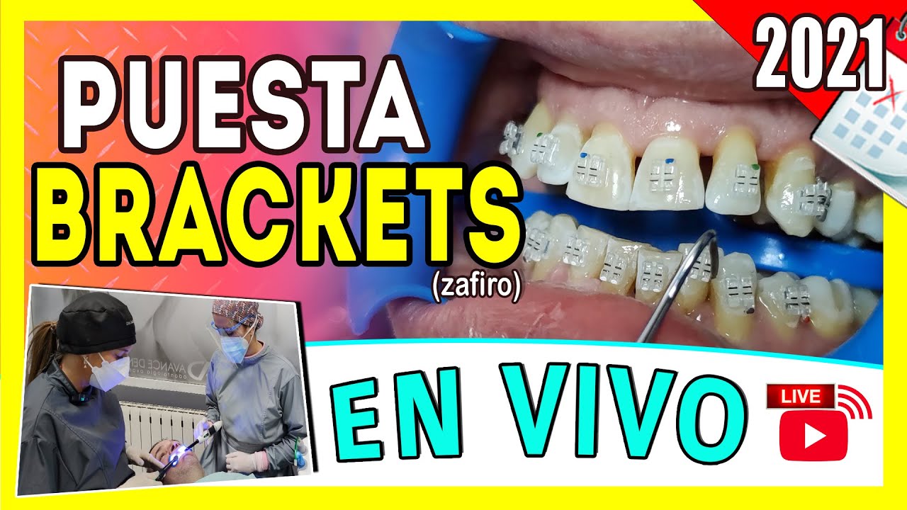 [🔴 En Vivo] Como se 𝗣𝗢𝗡𝗘𝗡 𝗟𝗢𝗦 𝗕𝗥𝗔𝗖𝗞𝗘𝗧𝗦 por PRIMERA VEZ - INSTALACIÓN de Brackets Paso A Paso 👌