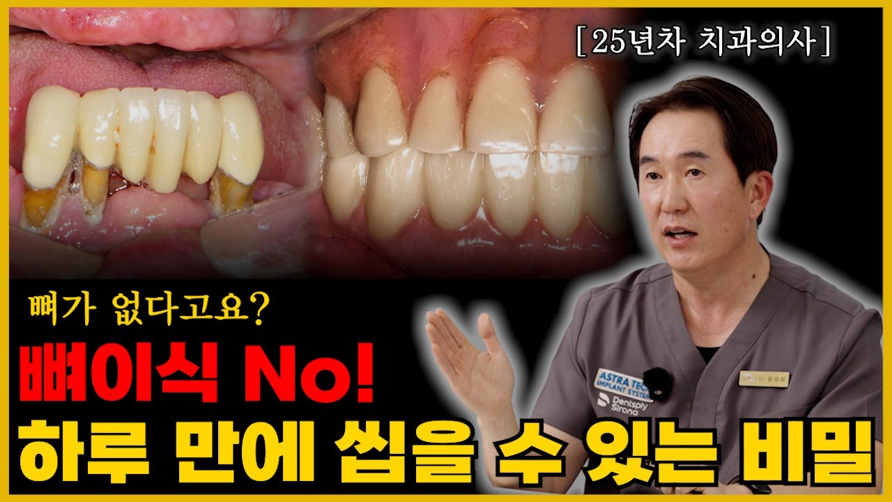 뼈이식 없이 가능한 풀아치 임플란트/ 25년차 치과의사 실제사례 [천안]