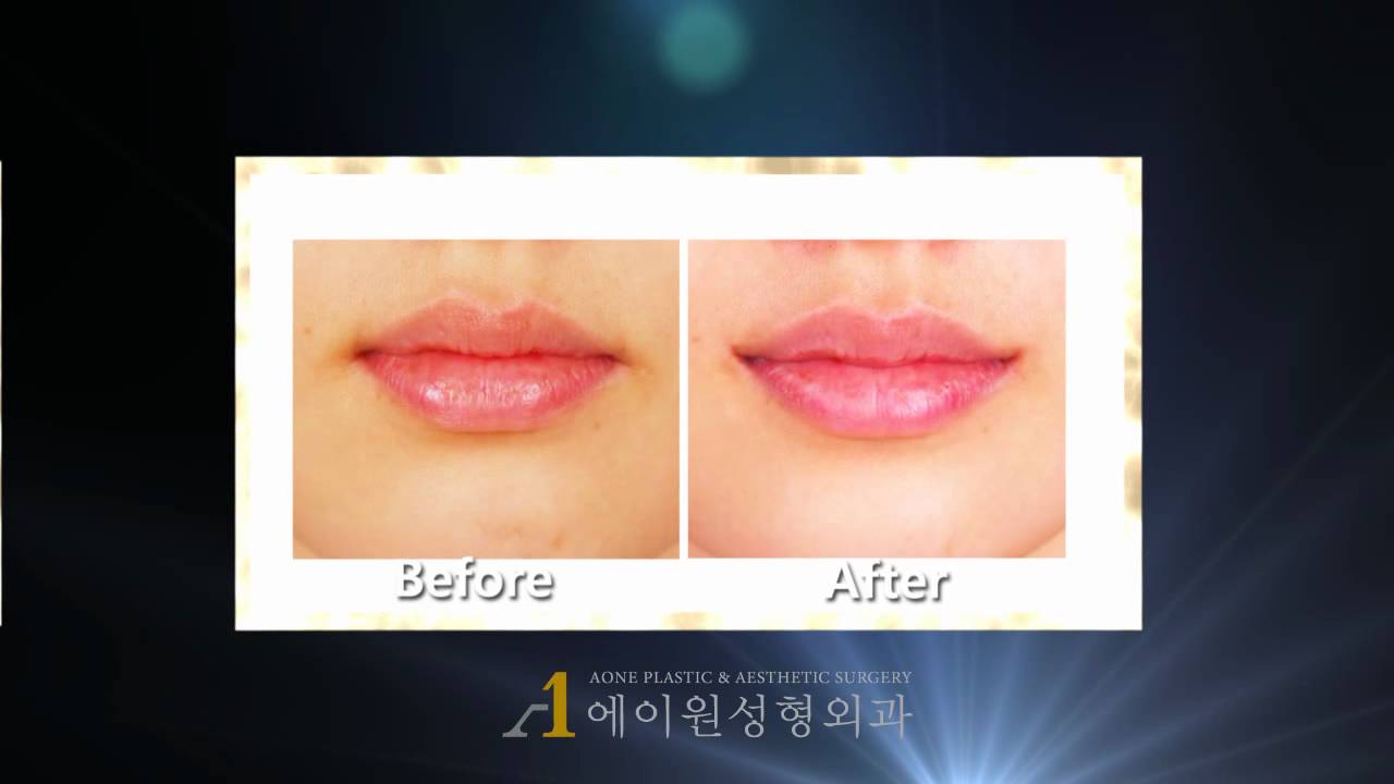 [KOREA] Mouth corner lift  before & after plastic surgery