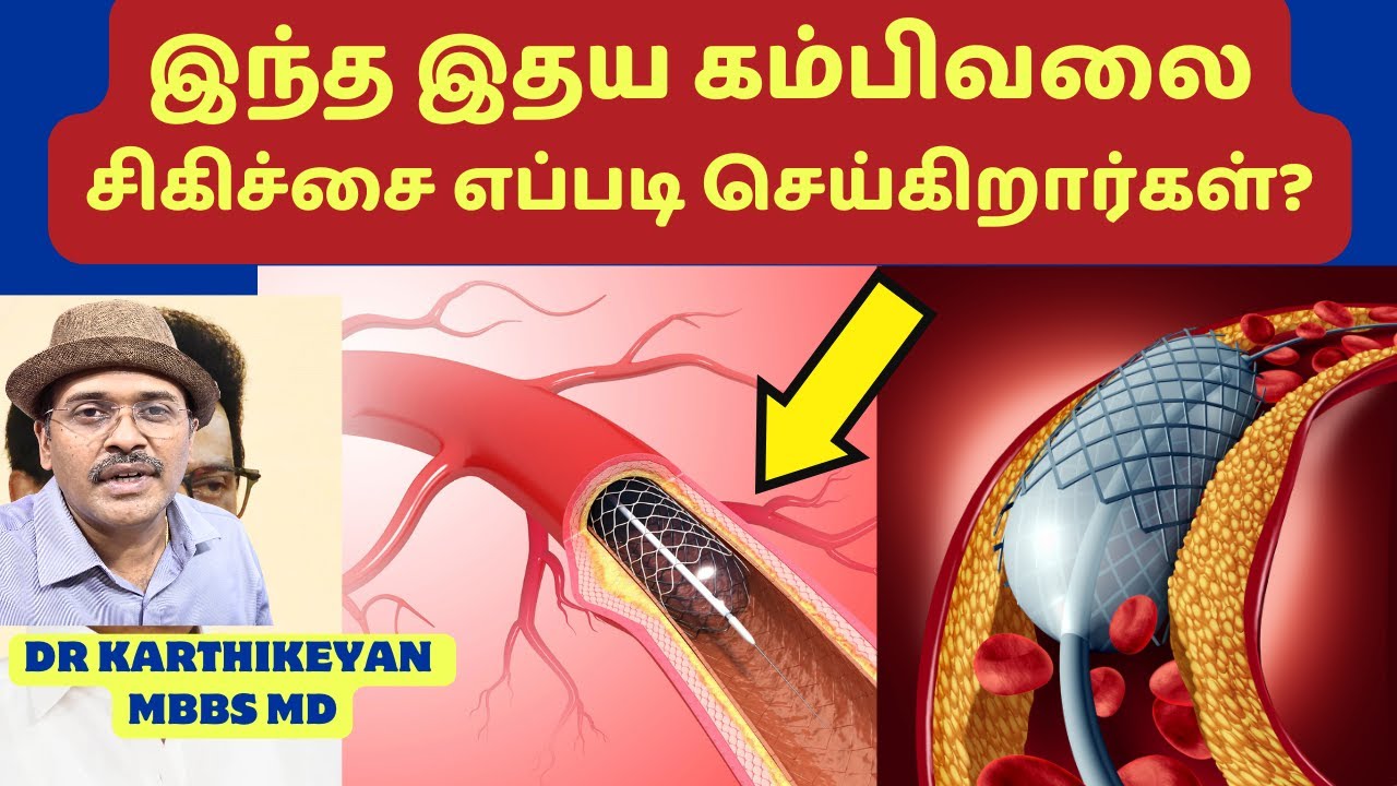 ஸ்டண்ட் (கம்பிவலை) இதயசிகிச்சை பத்தி தெரிஞ்சிக்கோங்க!   | coronary artery stenting procedure!