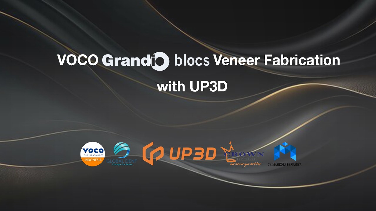 Digital Workflow VOCO CAD/CAM Grandio Blocs with UP3D system (IOS, Soreal & Milling) Veneer