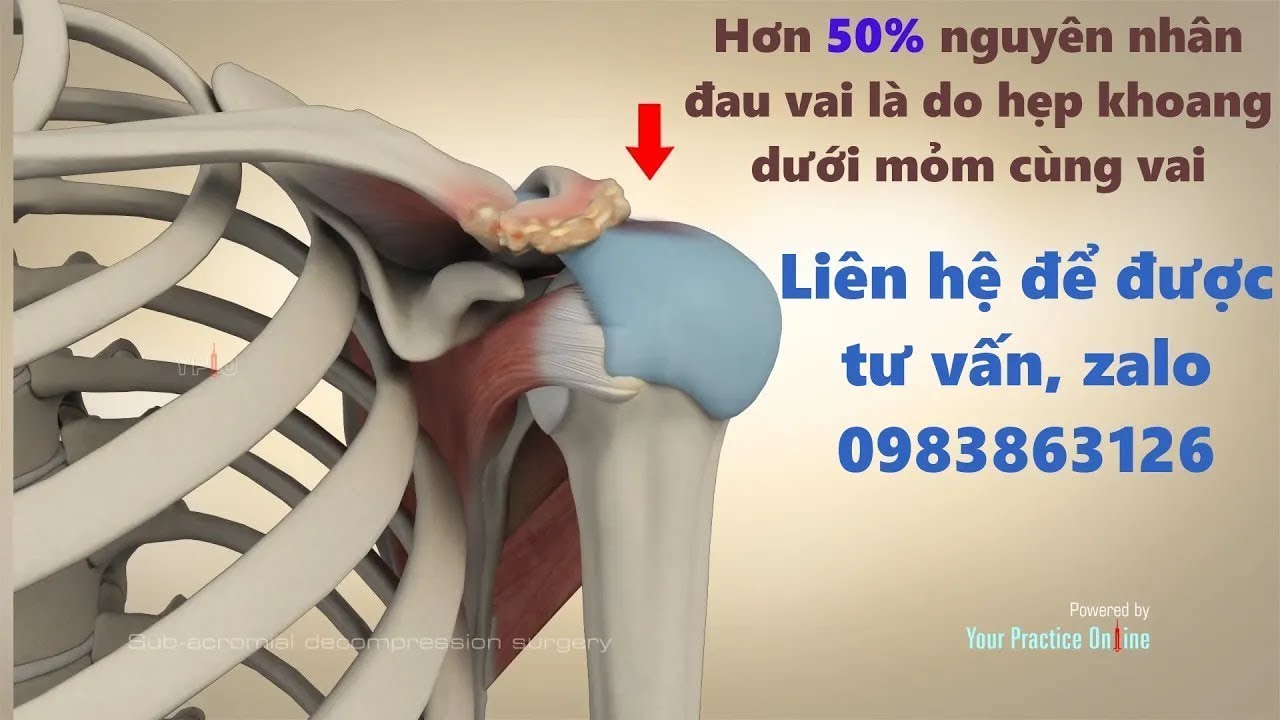 Hẹp Khoang Dưới Mỏm Cùng Vai - Nguyên Nhân Hàng Đầu Gây Đau Khớp Vai, Không Giơ Được Tay Lên