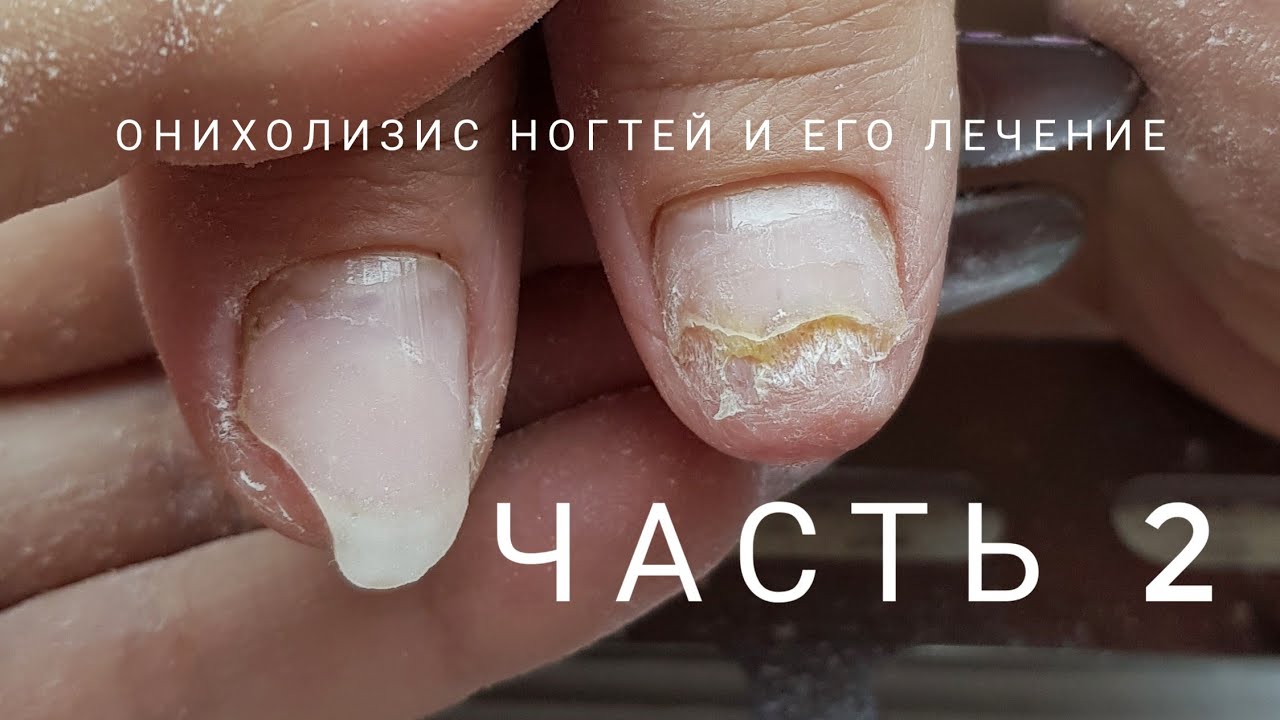 Oнихолизис часть 2, как вылечить онихолизис. Что такое онихолизис. Проблемные ногти.