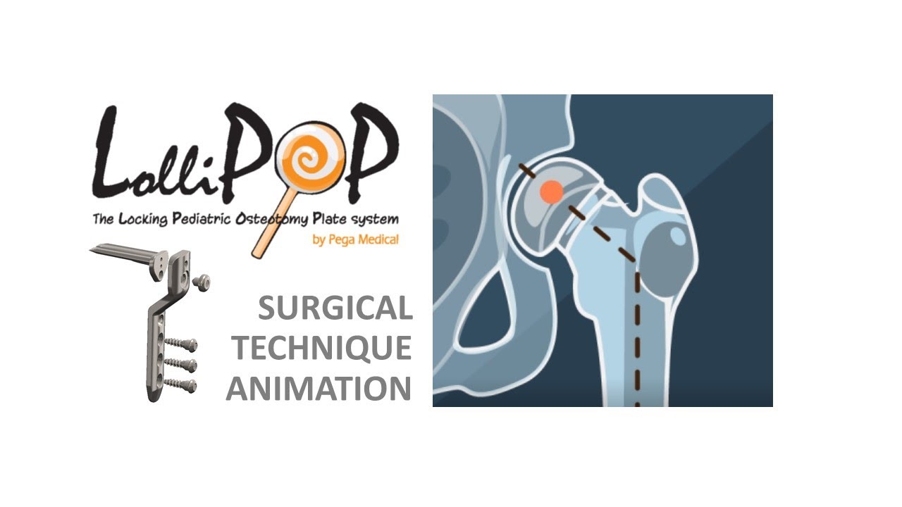 LolliPOP System by OrthoPediatrics Canada