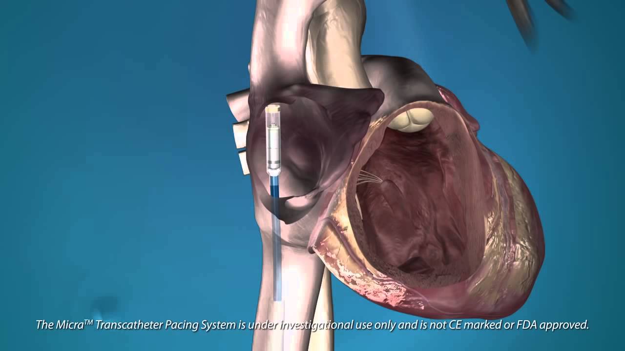 The Medtronic Micra Transcatheter (Pacing System)