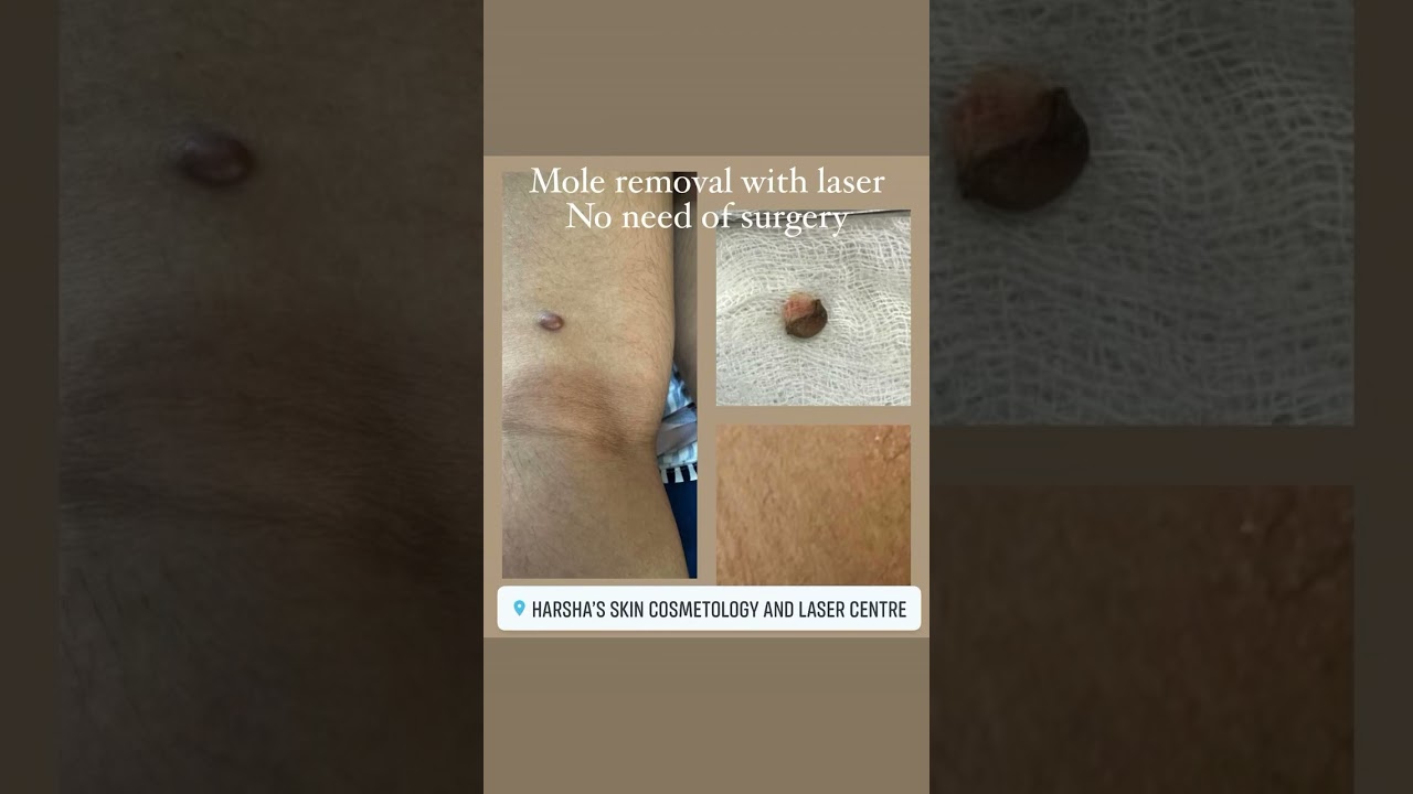 #skinsurgery #lasersurgery #moleremovaltreatment #moleremovalsurgery #MoleRemover #bestskindoctor