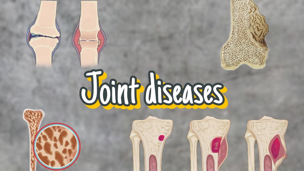 Joint diseases