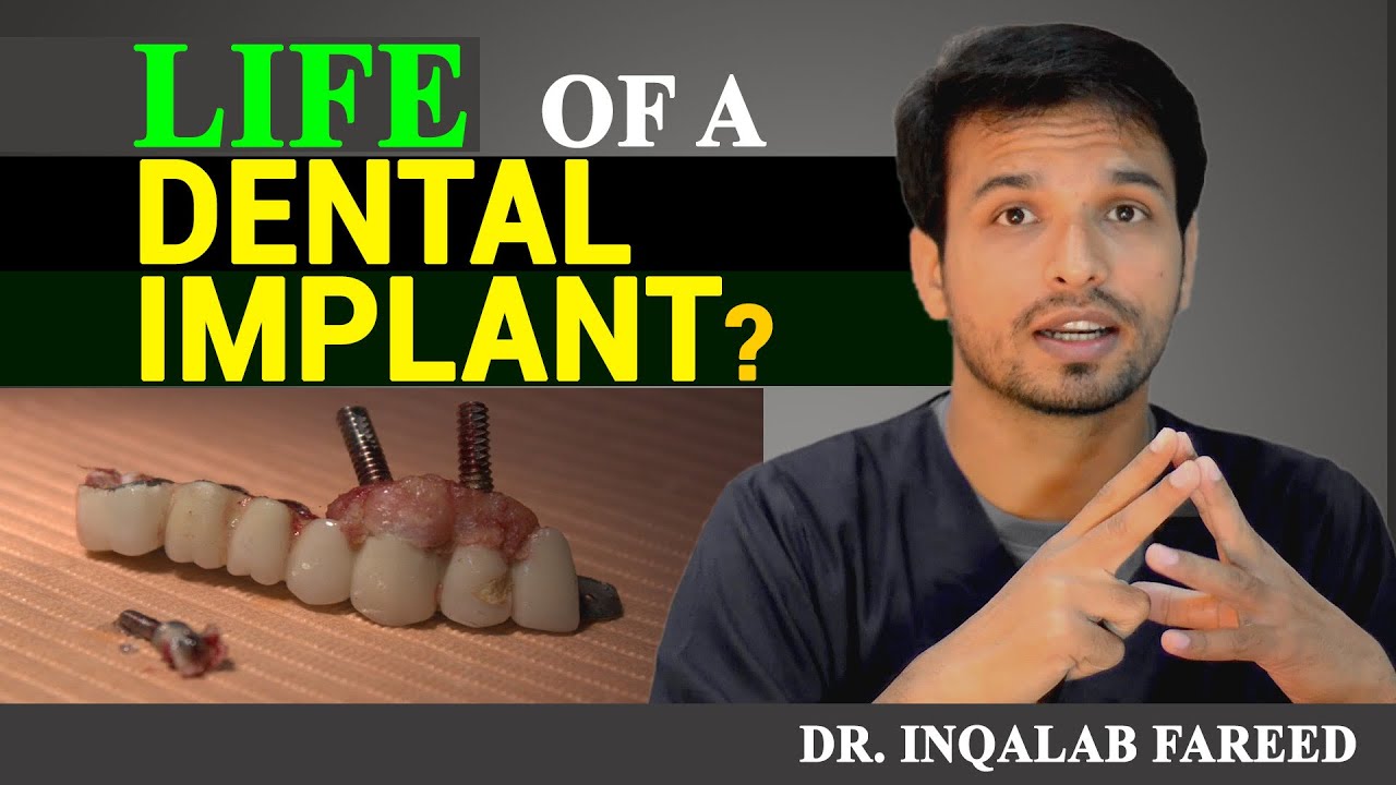 What is the Life of a Dental Implant? | Urdu | Hindi | @InqalabFareed