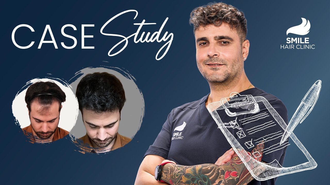 Case Studies: 3050 Grafts Transformed in 12 Months | Smile Hair Clinic - Hair Transplant