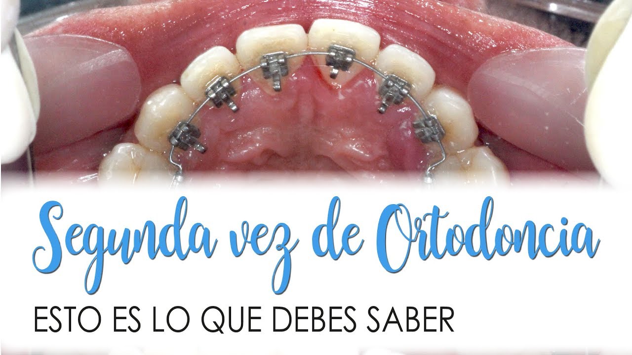 LO QUE DEBES SABER DE LA SEGUNDA VEZ DE ORTODONCIA