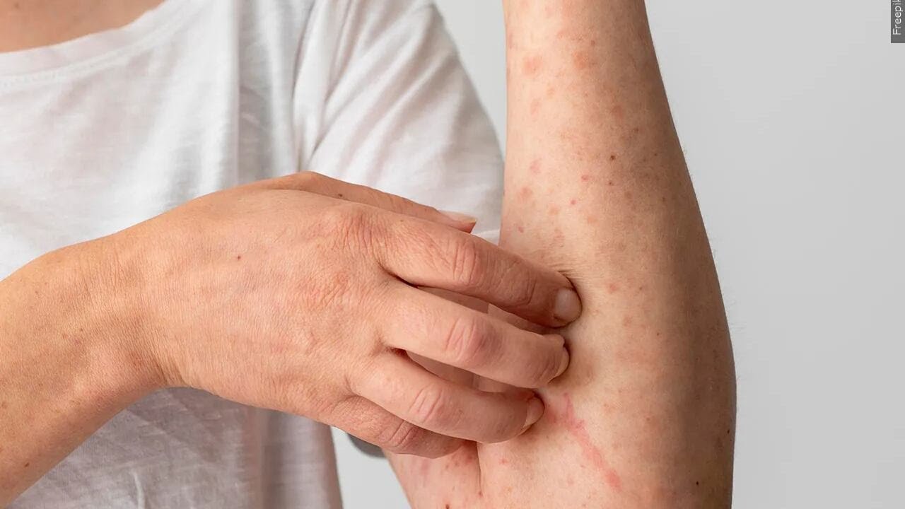S.C. measles outbreak gains 44 cases even as vaccinations rise