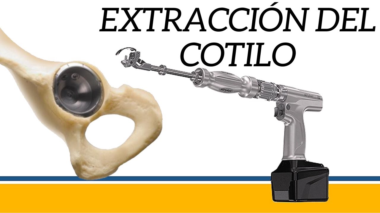 Motor EZout Buen recurso para extraccion cotilo