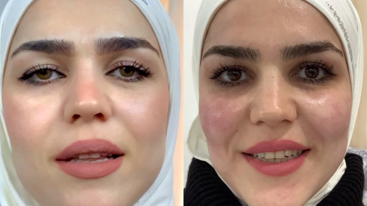 قبل وبعد البوتوكس والفلر | بيوتي فلوك💕