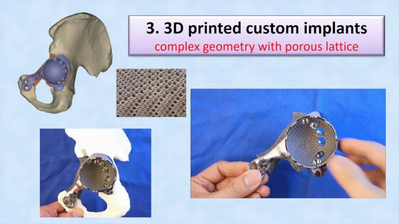 3D printing for patient-specific orthopedics – Video abstract [ID 99614]
