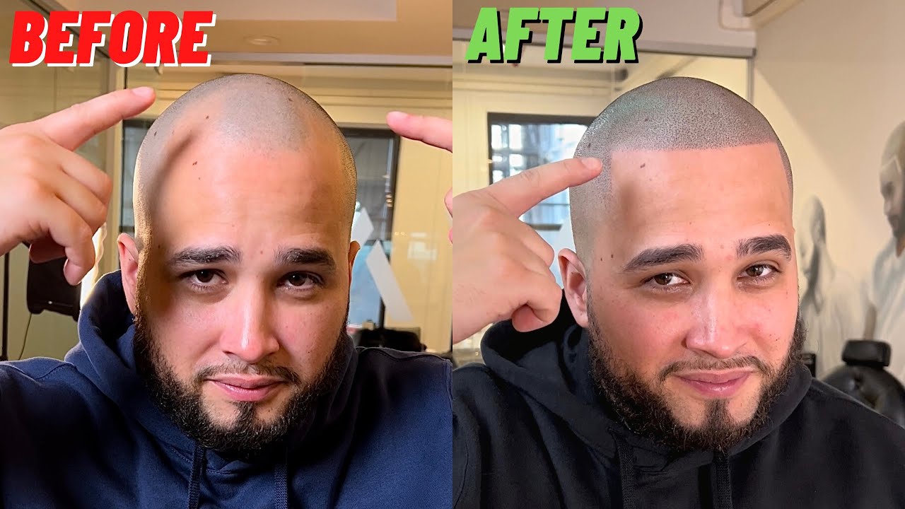 FRESH Scalp Micropigmentation Treatment in New York City, NY