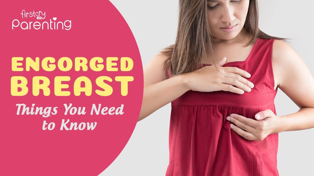Breast Engorgement - Symptoms, Causes & Remedies
