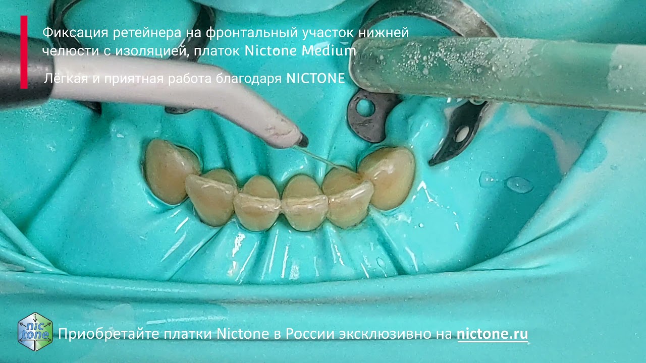 Изоляция нижних фронтальных зубов с фиксацией раббердам на коронках 45,34 для фиксации ретейнера 4K