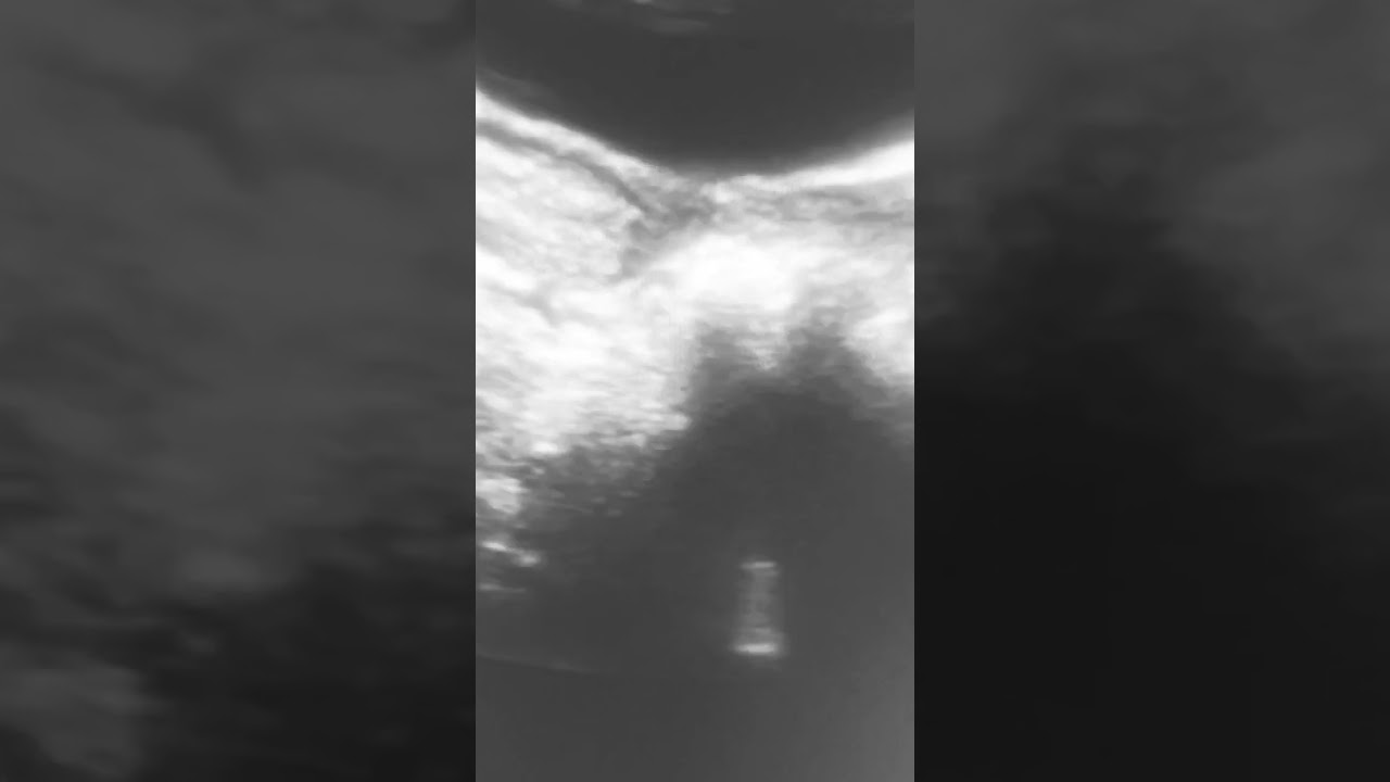 Endometritis, endometritis in ultrasound, endometritis in USG.