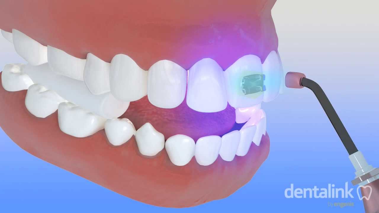 Colocaci&oacute;n de brackets - PROCESO de cementaci&oacute;n paso a paso 3D