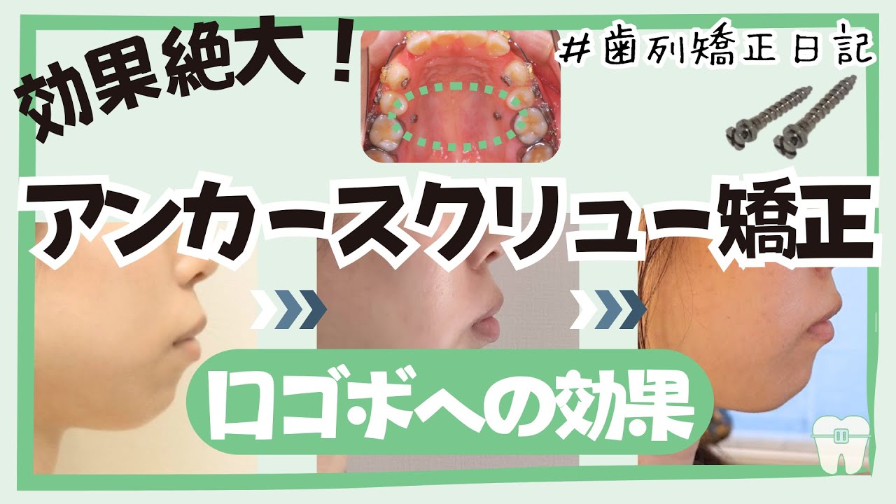 【歯列矯正日記】アンカースクリュー矯正は口ゴボに効果絶大！口元の変化や流れ