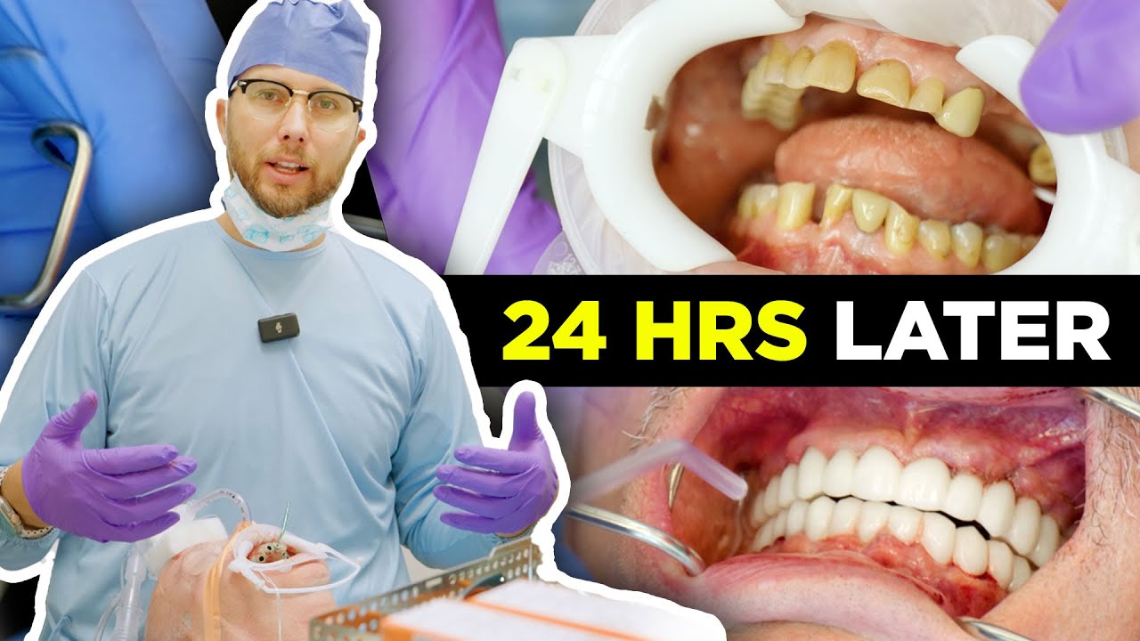 Implants and Bridges: Smile Restoration Looks and Feels Natural Without Bone Removal or Fake Gums