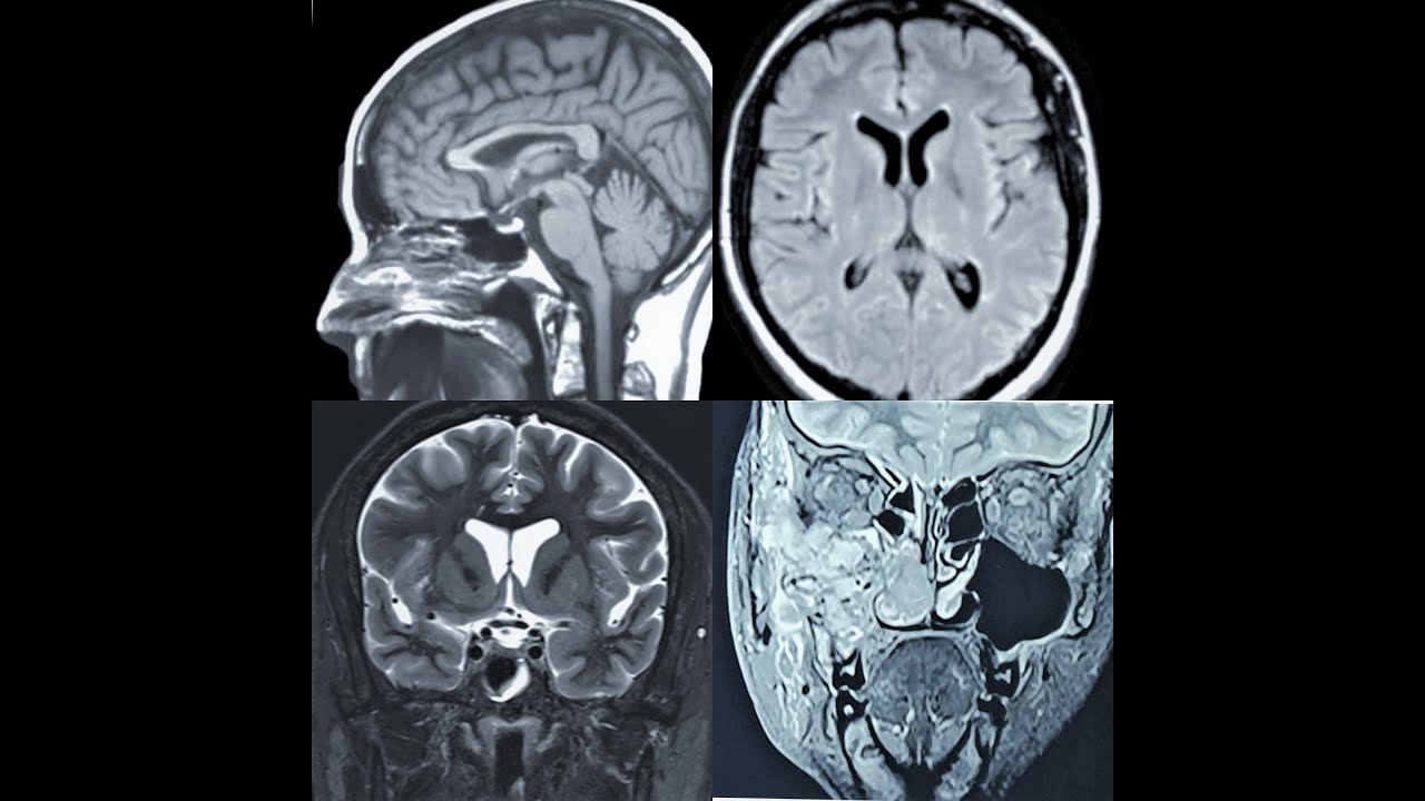 MRI ( BRAIN + PNS ) IN ENT & SKULL BASE