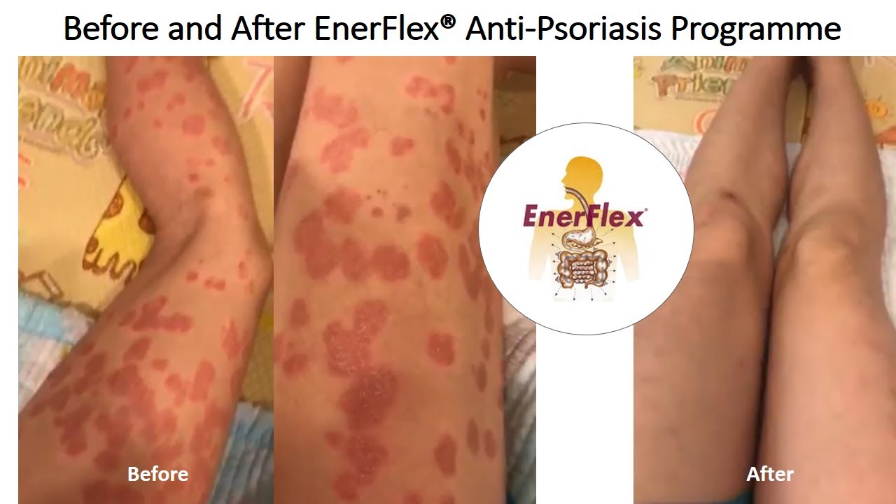 Miraculous Reversal of Plaque Psoriasis in 2 Months by EnerFlex Nutrition! No Scam at all!