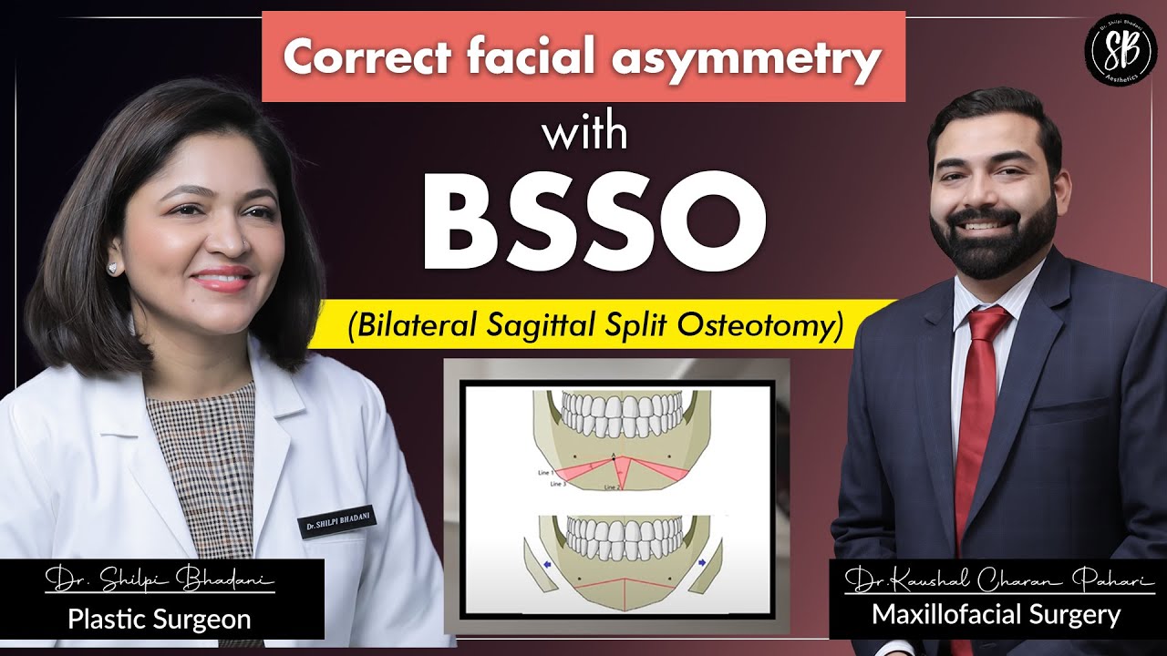 Correction of Misaligned Jaw & Facial Asymmetry | Bilateral Sagittal Split Osteotomy (BSSO) Surgery