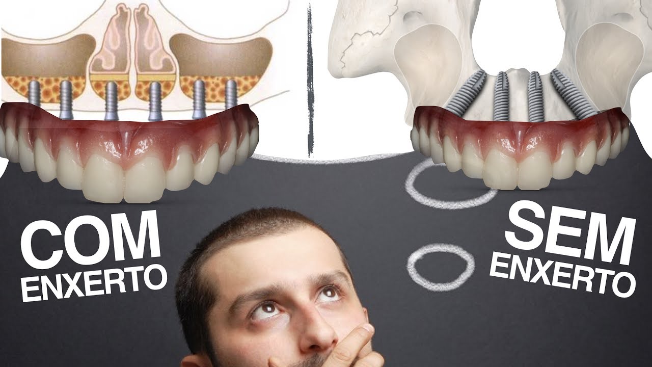 DENTES FIXOS:  Com Enxerto Ósseo OU Sem Enxerto Ósseo (Técnica All on 4)?