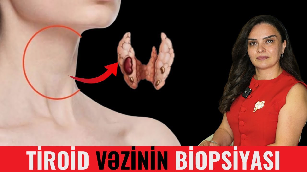 Tiroid vəzindəki düyünü Biopsiya etmək təhlükəlidir?