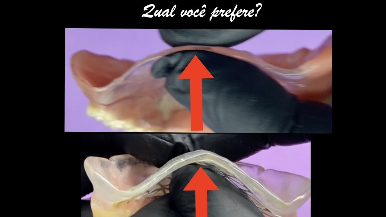 Problemas com o céu da boca grosso da prótese?