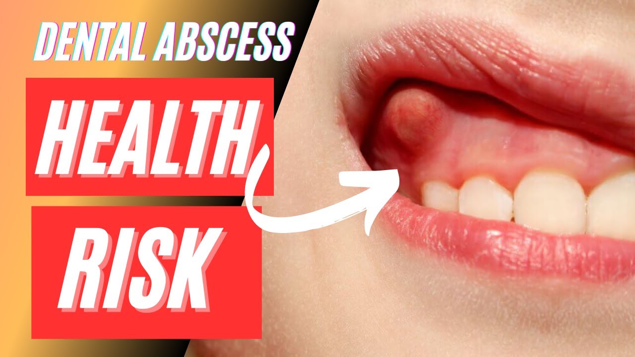 Dental Abscess Causes, Symptoms, and Essential Treatments