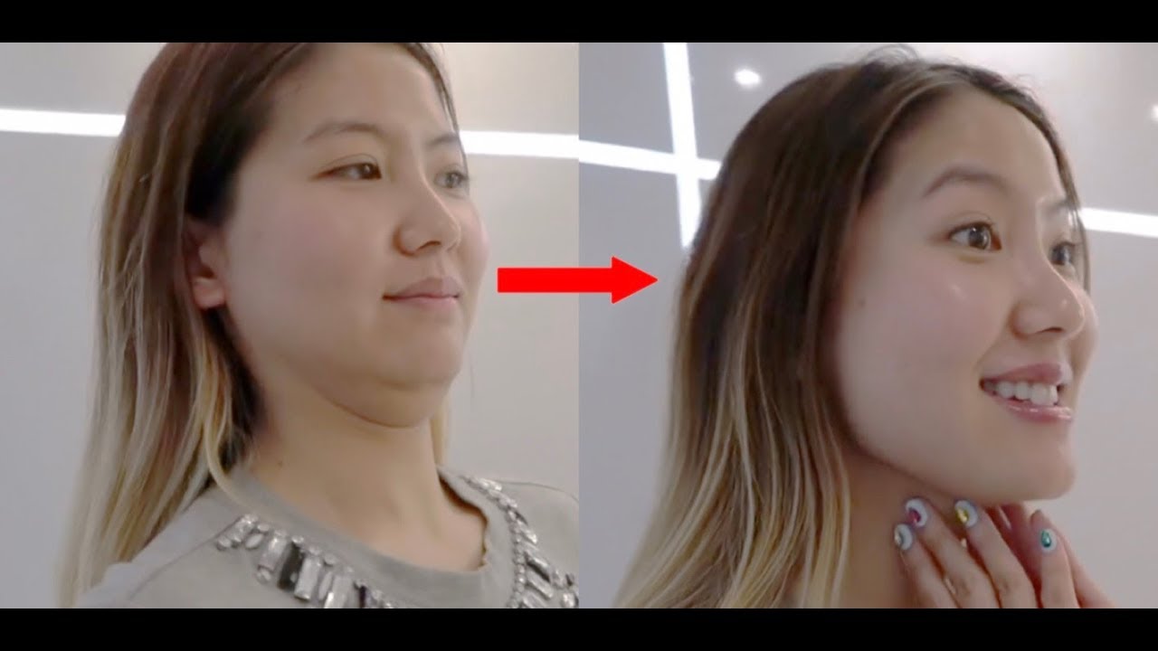 HIFU Shurink facelift and Lip Fillers | Seoul Guide Medical