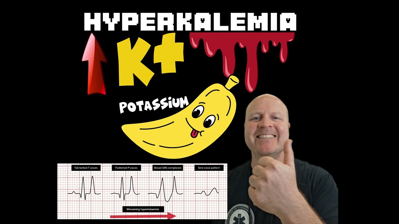 Why Hyperkalemia causes a widened QRS complex on the ECG : Explained
