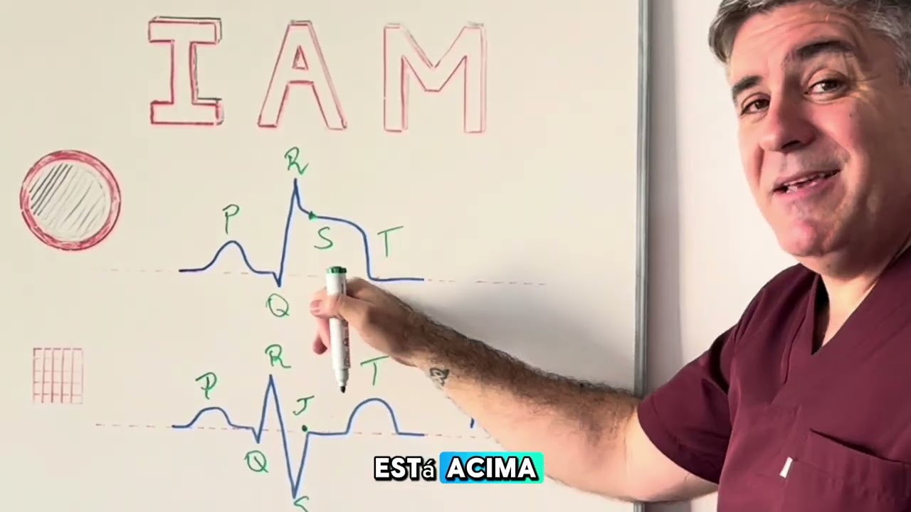 Como identificar SUPRA ou INFRA no ECG - melhor explicação ✅