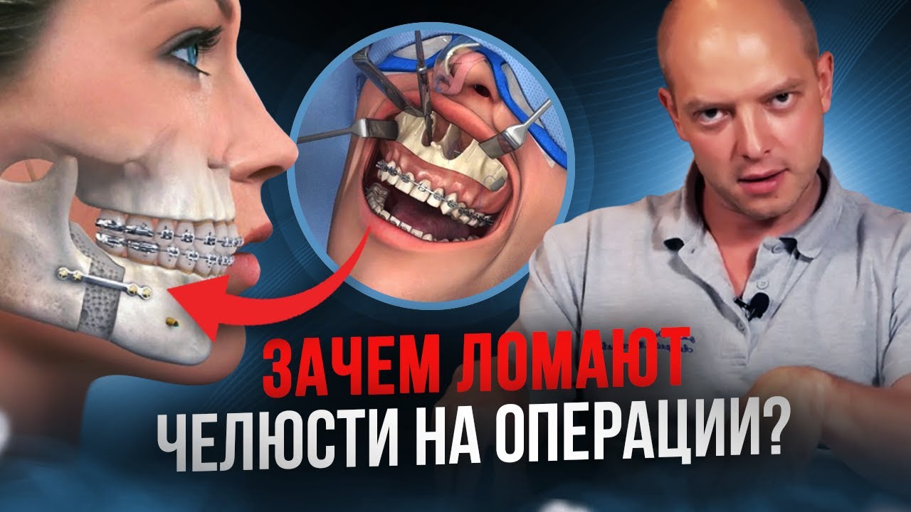 Как исправляют прикус хирургическим путем? Ортогнатическая хирургия.