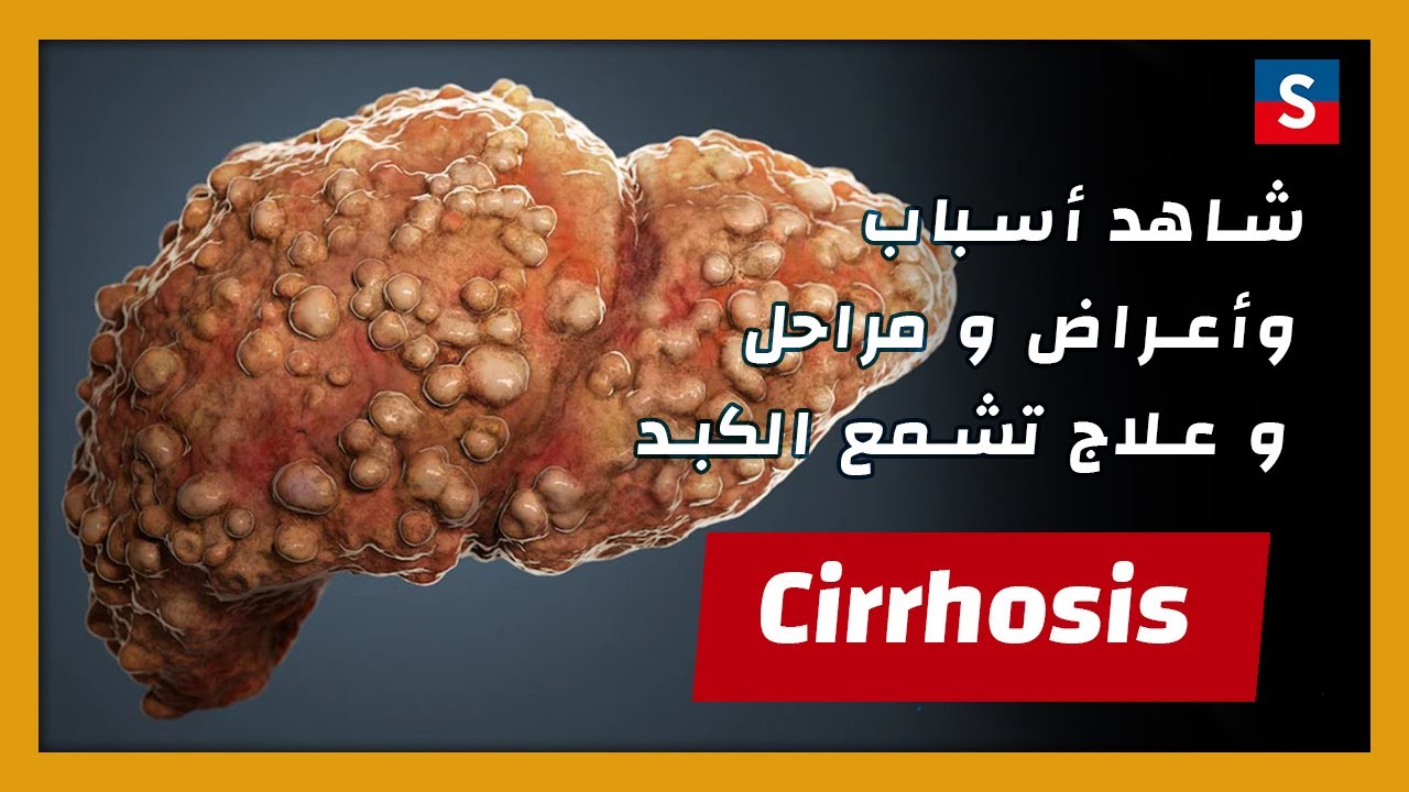 علاج تشمع الكبد