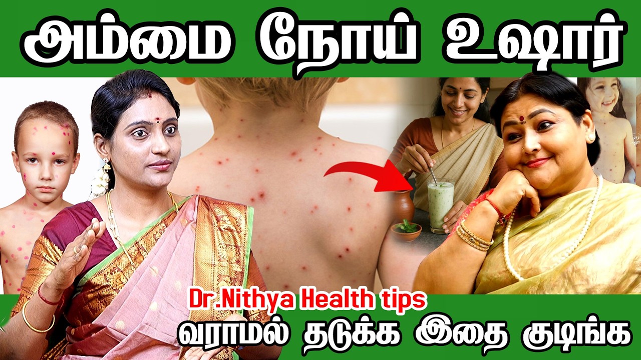 அம்மை வேகமாக தமிழகத்தில் பரவுகிறது! குளிக்கலாமா? வேப்பஇலை? சாப்பாடு? chicken pox in tamil |dr.nithya