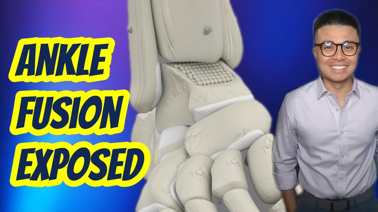 What REALLY happens during Ankle Fusion Surgery