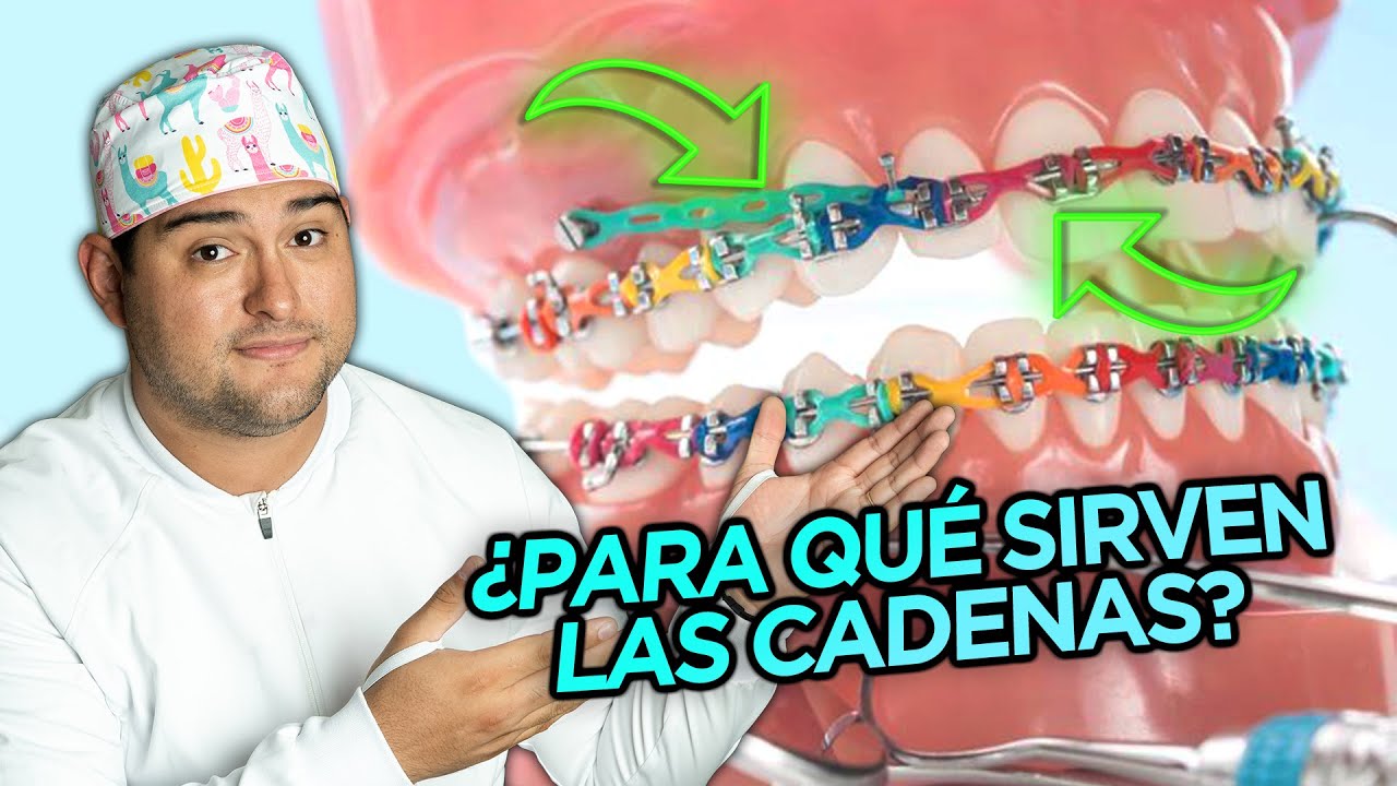 ¿PARA QUE SIRVEN LAS CADENAS ELÁSTICAS EN TUS BRACKETS? ¿CUANDO SI Y CUANDO NO en tu ORTODONCIA?