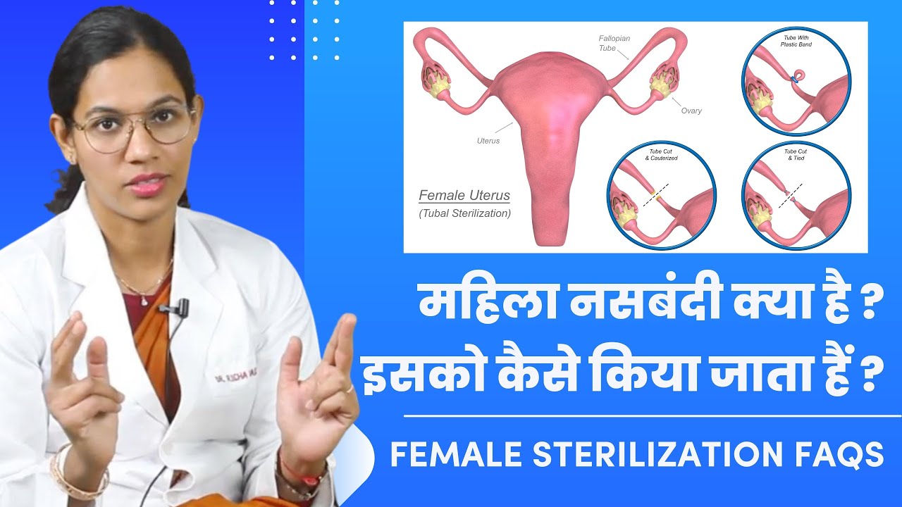 Female sterilization FAQs ,  महिला नसबंदी# बच्चा नहीं करने का आसान तरीका#