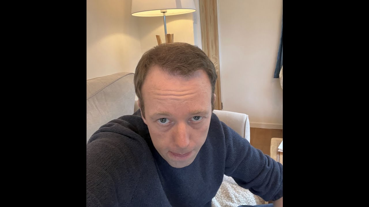 7 Month: Video Diary. 2000 FUE with Dr Ball Maitland Clinic UK