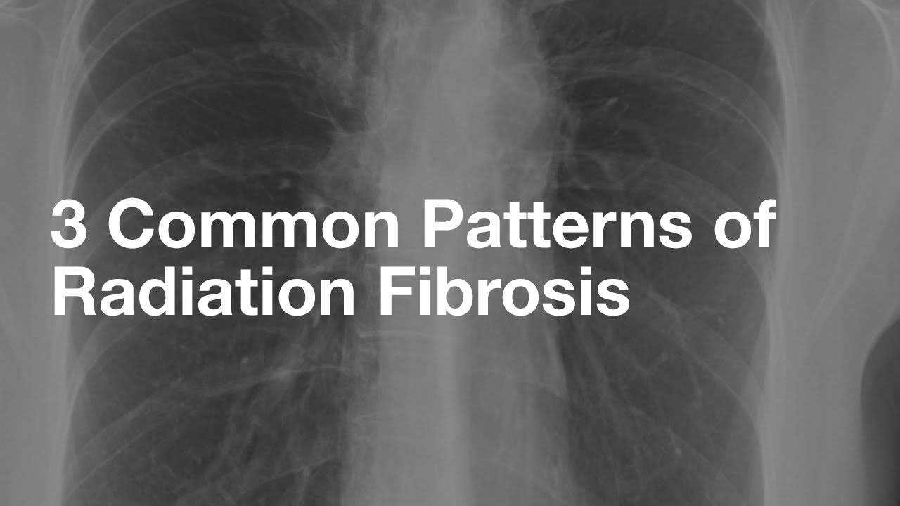 3 Common Patterns of Radiation Fibrosis (not from lung cancer)