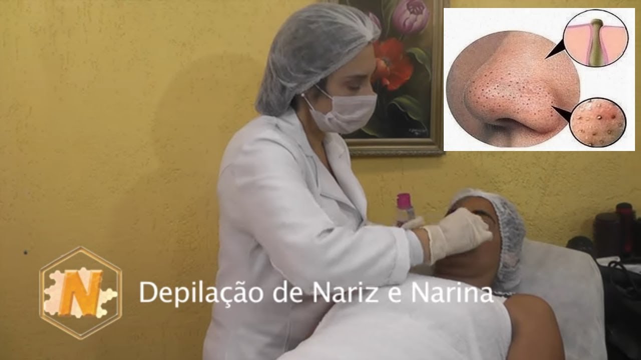 Como Tirar os CRAVOS do Nariz,  em 2 Minutos com Cera quente